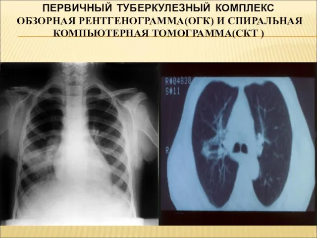 ПЕРВИЧНЫЙ ТУБЕРКУЛЕЗНЫЙ КОМПЛЕКС ОБЗОРНАЯ РЕНТГЕНОГРАММА(ОГК) И СПИРАЛЬНАЯ КОМПЬЮТЕРНАЯ ТОМОГРАММА(СКТ )