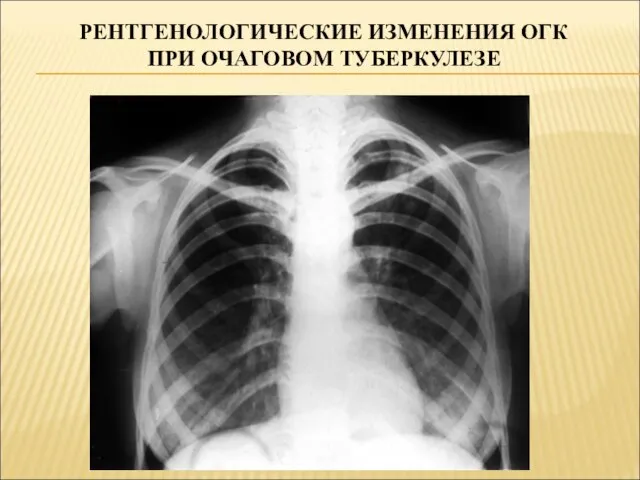 РЕНТГЕНОЛОГИЧЕСКИЕ ИЗМЕНЕНИЯ ОГК ПРИ ОЧАГОВОМ ТУБЕРКУЛЕЗЕ