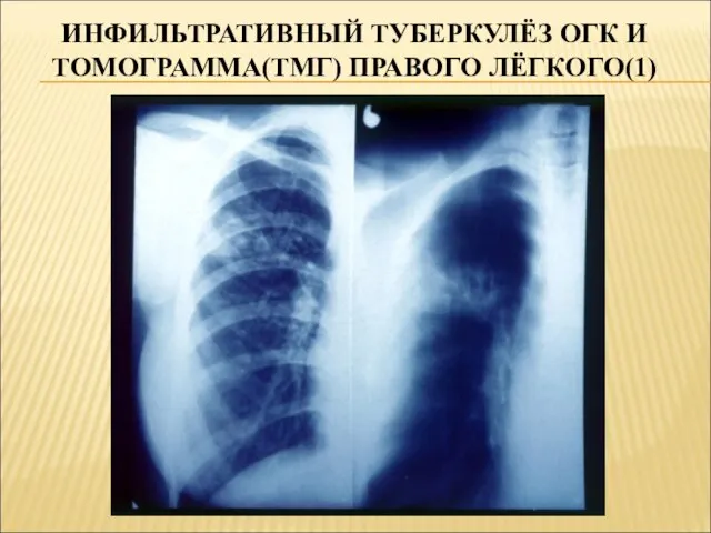 ИНФИЛЬТРАТИВНЫЙ ТУБЕРКУЛЁЗ ОГК И ТОМОГРАММА(ТМГ) ПРАВОГО ЛЁГКОГО(1)