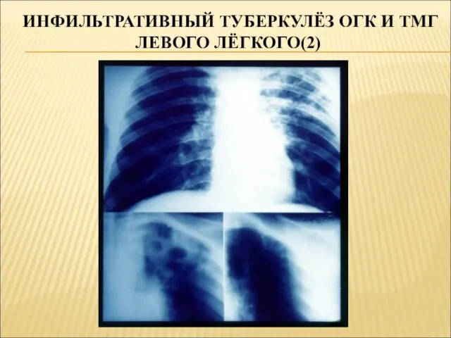 ИНФИЛЬТРАТИВНЫЙ ТУБЕРКУЛЁЗ ОГК И ТМГ ЛЕВОГО ЛЁГКОГО(2)
