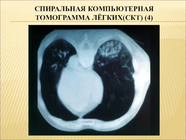 СПИРАЛЬНАЯ КОМПЬЮТЕРНАЯ ТОМОГРАММА ЛЁГКИХ(СКТ) (4)