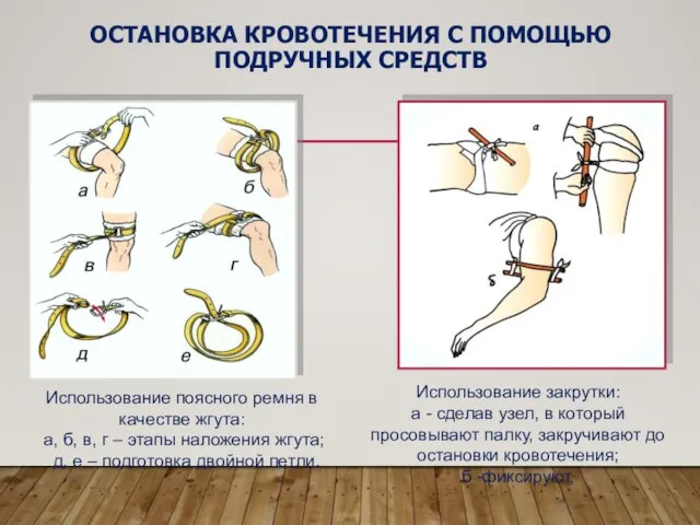 ОСТАНОВКА КРОВОТЕЧЕНИЯ С ПОМОЩЬЮ ПОДРУЧНЫХ СРЕДСТВ Использование поясного ремня в качестве