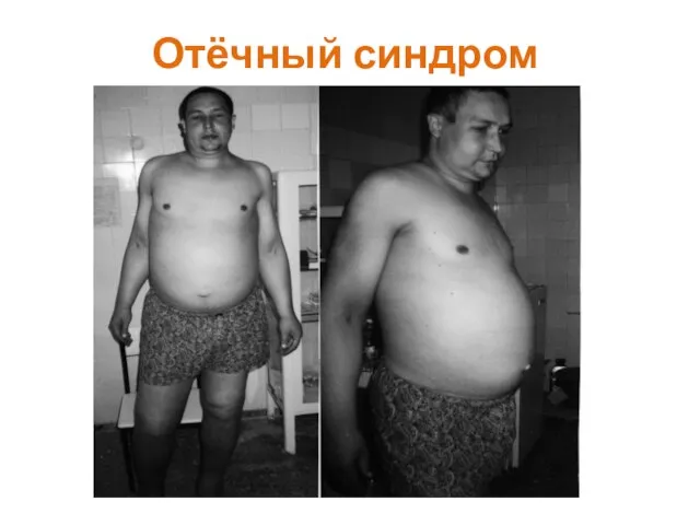 Отёчный синдром