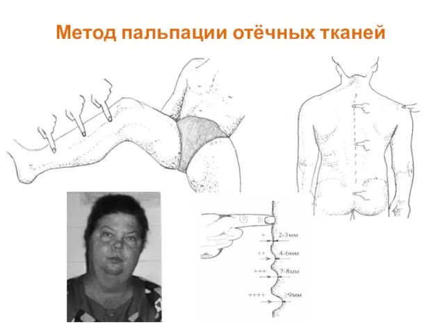 Метод пальпации отёчных тканей