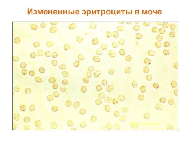 Измененные эритроциты в моче клетки-мишени