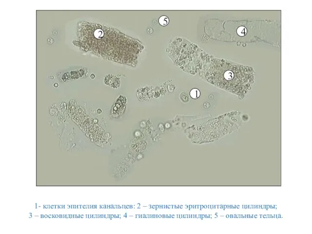 1- клетки эпителия канальцев: 2 – зернистые эритроцитарные цилиндры; 3 –