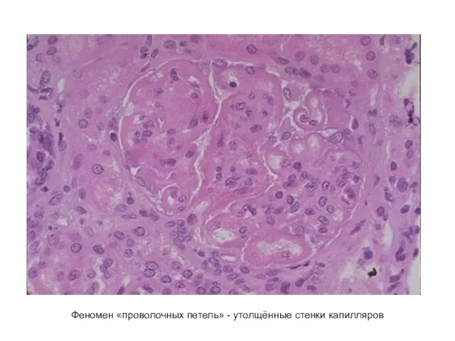 Феномен «проволочных петель» - утолщённые стенки капилляров