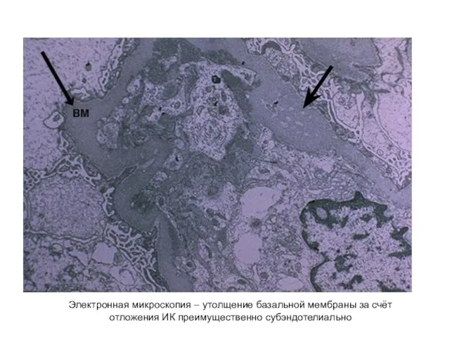 Электронная микроскопия – утолщение базальной мембраны за счёт отложения ИК преимущественно субэндотелиально