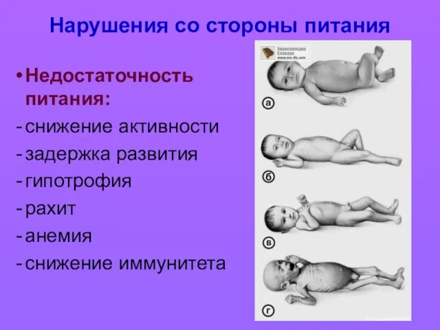 Нарушения со стороны питания Недостаточность питания: снижение активности задержка развития гипотрофия рахит анемия снижение иммунитета