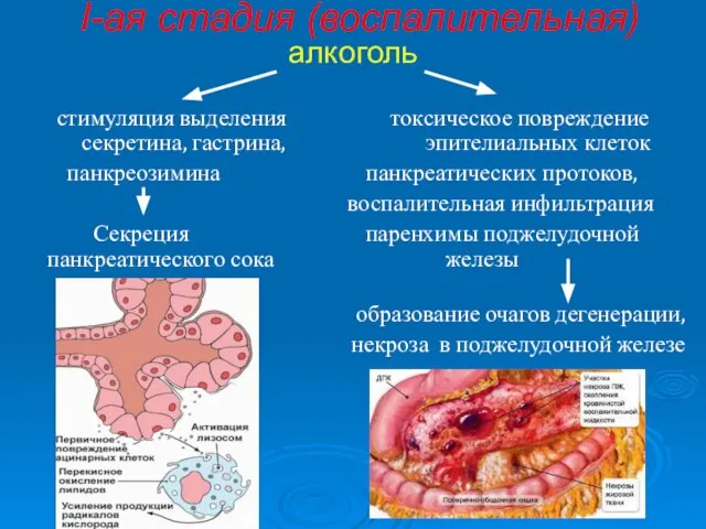 I-ая стадия (воспалительная) алкоголь стимуляция выделения токсическое повреждение секретина, гастрина, эпителиальных