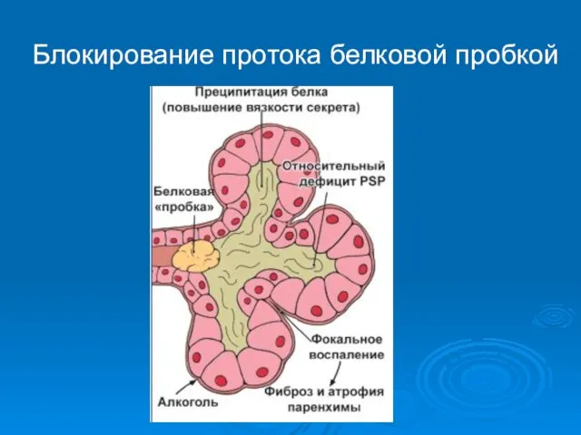 Блокирование протока белковой пробкой