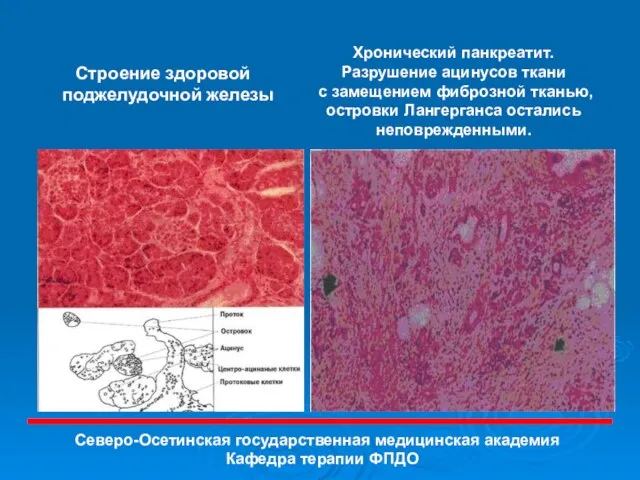 Строение здоровой поджелудочной железы Хронический панкреатит. Разрушение ацинусов ткани с замещением