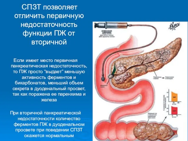 СПЗТ позволяет отличить первичную недостаточность функции ПЖ от вторичной Если имеет