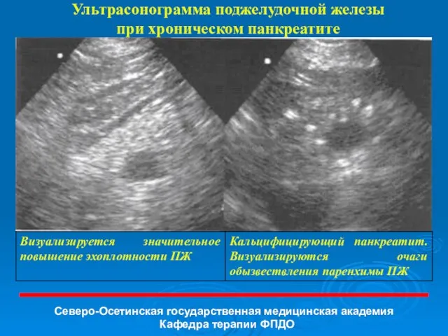 Ультрасонограмма поджелудочной железы при хроническом панкреатите Северо-Осетинская государственная медицинская академия Кафедра терапии ФПДО