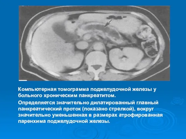 Компьютерная томограмма поджелудочной железы у больного хроническим панкреатитом. Определяется значительно дилатированный