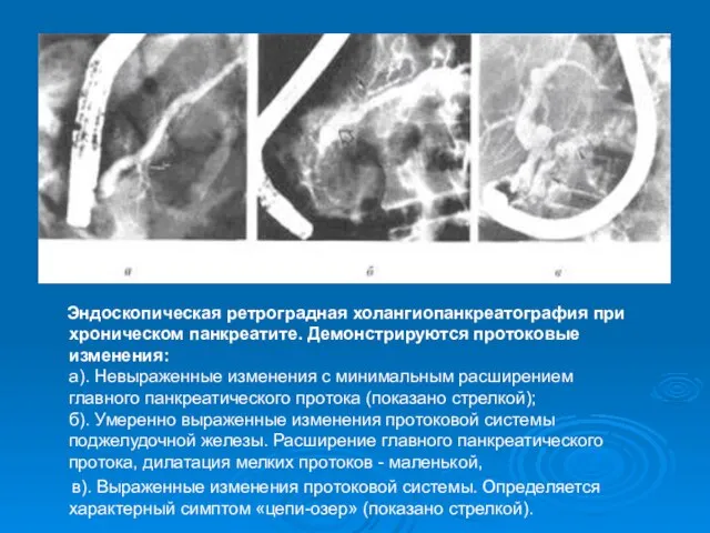 Эндоскопическая ретроградная холангиопанкреатография при хроническом панкреатите. Демонстрируются протоковые изменения: а). Невыраженные