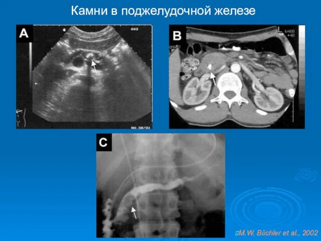 Камни в поджелудочной железе M.W. Büchler et al., 2002