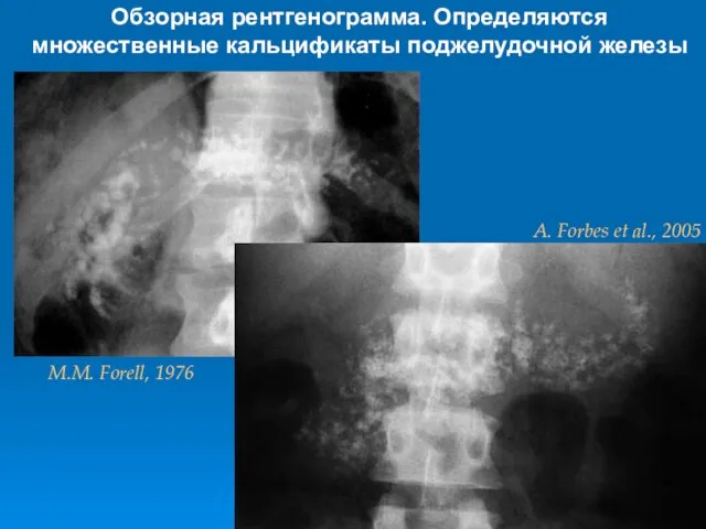 Обзорная рентгенограмма. Определяются множественные кальцификаты поджелудочной железы