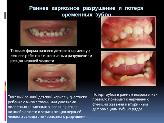 Раннее кариозное разрушение и потеря временных зубов Потеря зубов в раннем