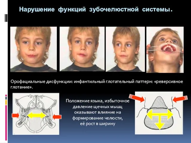 Нарушение функций зубочелюстной системы. Орофациальные дисфункции: инфантильный глотательный паттерн: «реверсивное глотание».