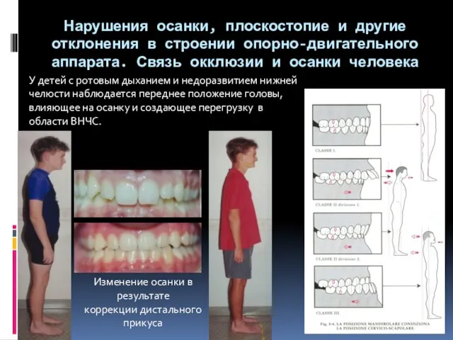 Нарушения осанки, плоскостопие и другие отклонения в строении опорно-двигательного аппарата. Связь