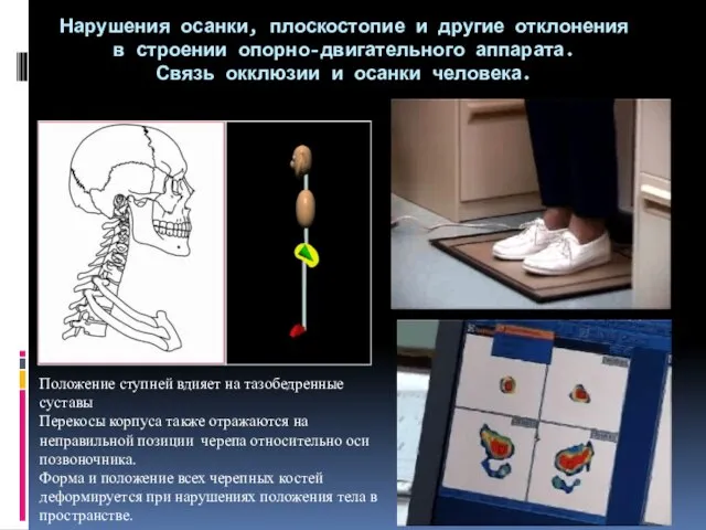 Нарушения осанки, плоскостопие и другие отклонения в строении опорно-двигательного аппарата. Связь