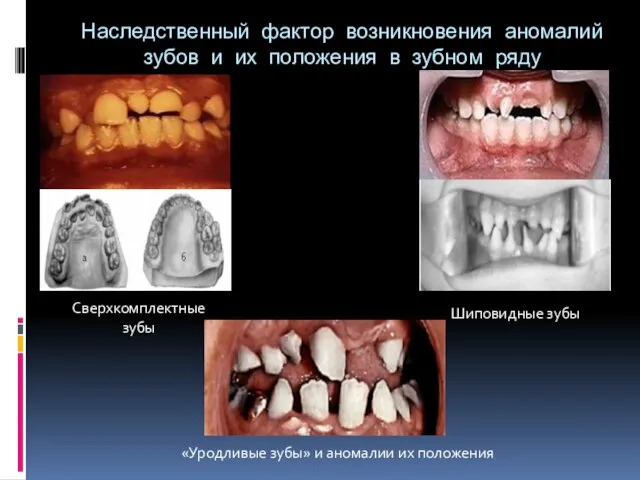 Наследственный фактор возникновения аномалий зубов и их положения в зубном ряду