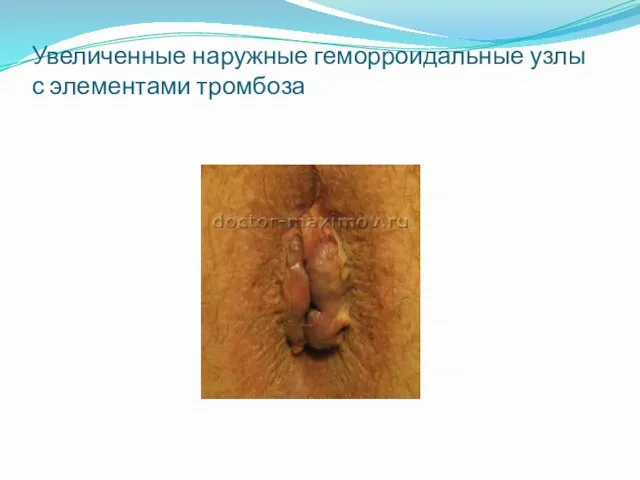 Увеличенные наружные геморроидальные узлы с элементами тромбоза