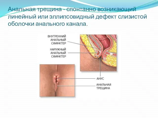 Анальная трещина - спонтанно возникающий линейный или эллипсовидный дефект слизистой оболочки анального канала.