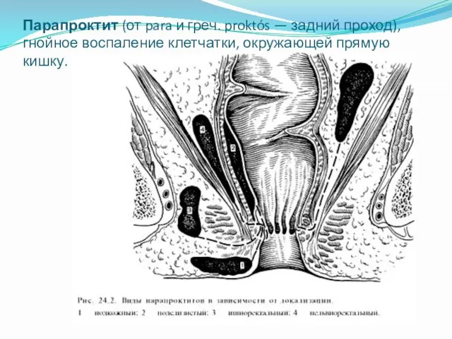 Парапроктит (от para и греч. proktós — задний проход), гнойное воспаление клетчатки, окружающей прямую кишку.