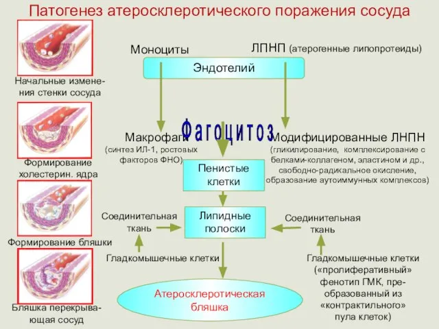 Патогенез атеросклеротического поражения сосуда Эндотелий Моноциты ЛПНП (атерогенные липопротеиды) Макрофаги Модифицированные