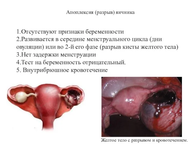 1.Отсутствуют признаки беременности 2.Развивается в середине менструального цикла (дни овуляции) или