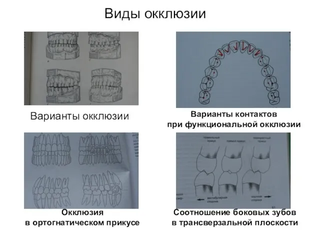 Виды окклюзии Варианты окклюзии Варианты контактов при функциональной окклюзии Окклюзия в