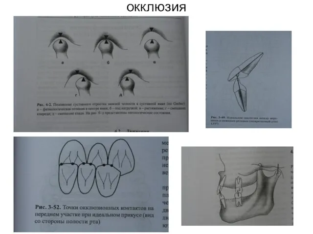 окклюзия