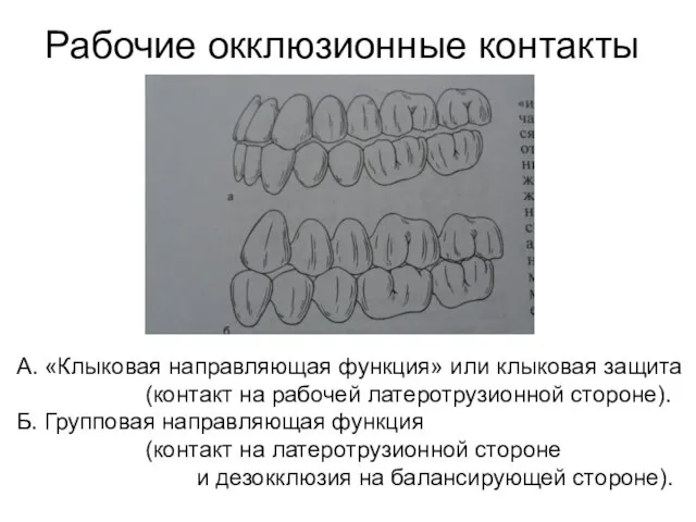 Рабочие окклюзионные контакты А. «Клыковая направляющая функция» или клыковая защита (контакт