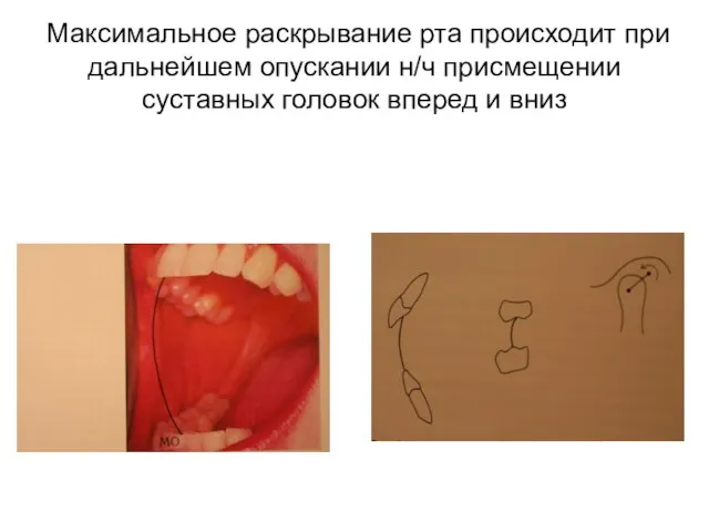 Максимальное раскрывание рта происходит при дальнейшем опускании н/ч присмещении суставных головок вперед и вниз