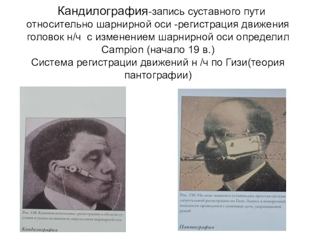 Кандилография-запись суставного пути относительно шарнирной оси -регистрация движения головок н/ч с