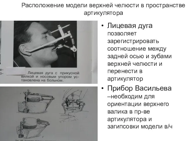 Расположение модели верхней челюсти в пространстве артикулятора Лицевая дуга прибор Васильева