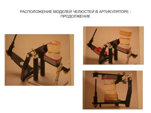 РАСПОЛОЖЕНИЕ МОДЕЛЕЙ ЧЕЛЮСТЕЙ В АРТИКУЛЯТОРЕ -ПРОДОЛЖЕНИЕ