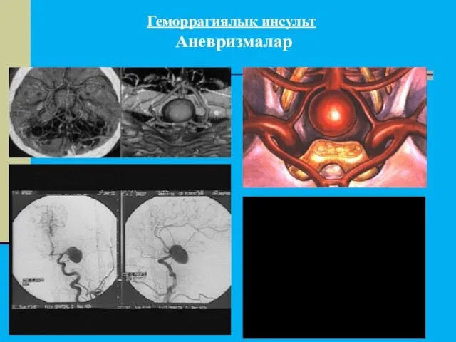 Геморрагиялық инсульт Аневризмалар