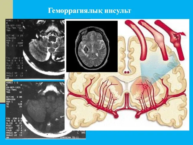 Геморрагиялық инсульт