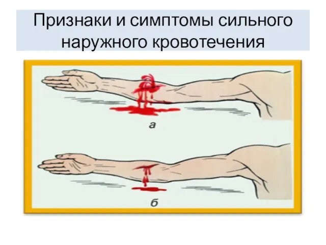 Признаки и симптомы сильного наружного кровотечения