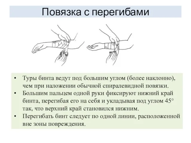 Повязка с перегибами Туры бинта ведут под большим углом (более наклонно),