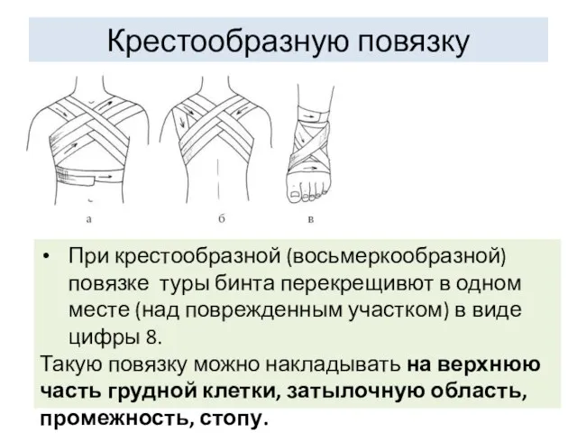 Крестообразную повязку При крестообразной (восьмеркообразной) повязке туры бинта перекрещивют в одном