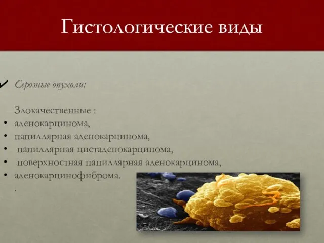 Гистологические виды Серозные опухоли: Злокачественные : аденокарцинома, папиллярная аденокарцинома, папиллярная цистаденокарцинома, поверхностная папиллярная аденокарцинома, аденокарцинофиброма. .