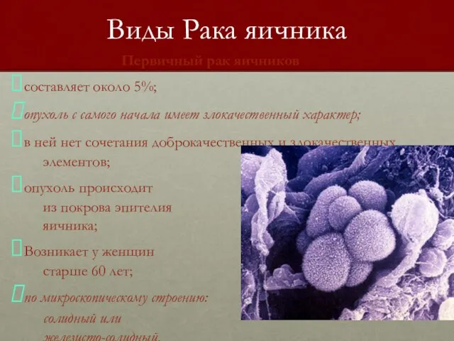 Виды Рака яичника Первичный рак яичников составляет около 5%; опухоль с