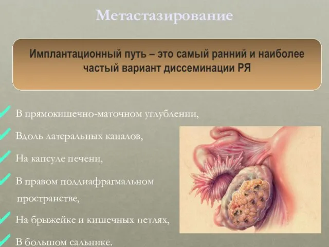 Метастазирование В прямокишечно-маточном углублении, Вдоль латеральных каналов, На капсуле печени, В