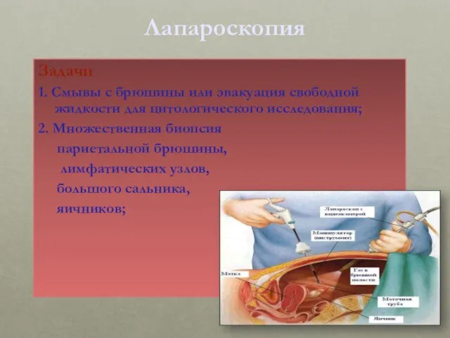 Лапароскопия Задачи 1. Смывы с брюшины или эвакуация свободной жидкости для