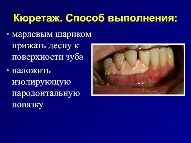 Кюретаж. Способ выполнения: марлевым шариком прижать десну к поверхности зуба наложить изолирующую пародонтальную повязку