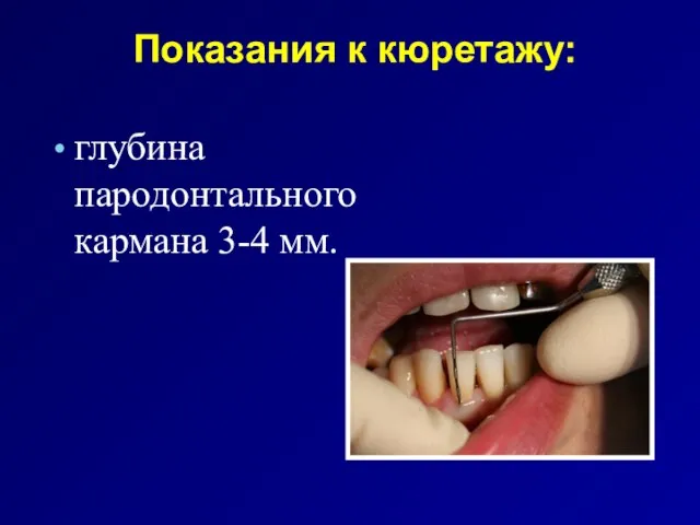 Показания к кюретажу: глубина пародонтального кармана 3-4 мм.